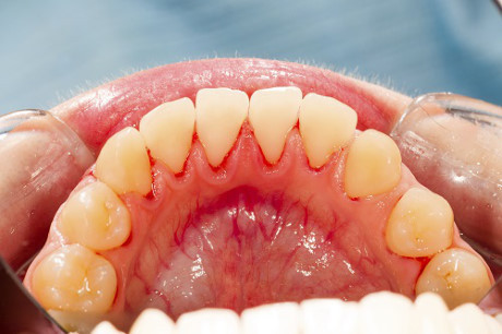 Nguyên nhân, triệu chứng và cách điều trị chảy máu lợi - Ảnh 1 Nguyen nhan, trieu chung va cach dieu tri chay mau loi - Anh 1