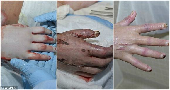 Cô gái 16 tuổi hồi phục nhanh kỳ diệu sau vụ cháy kinh hoàng