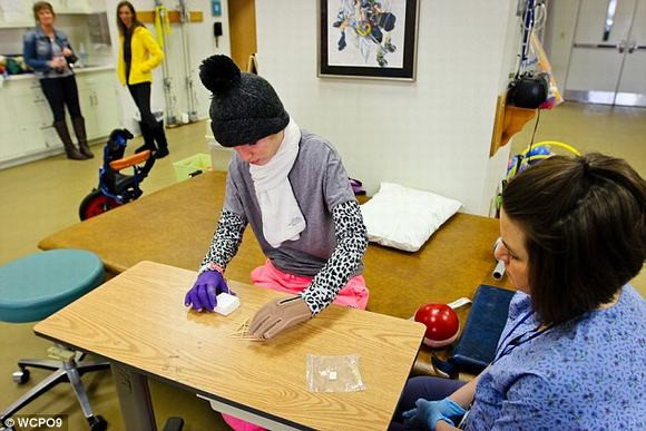 Cô gái 16 tuổi hồi phục nhanh kỳ diệu sau vụ cháy kinh hoàng