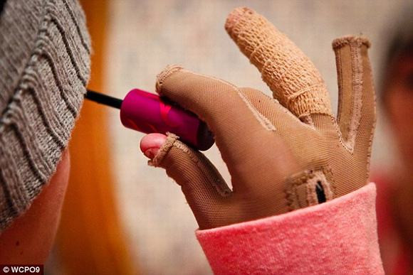 Cô gái 16 tuổi hồi phục nhanh kỳ diệu sau vụ cháy kinh hoàng