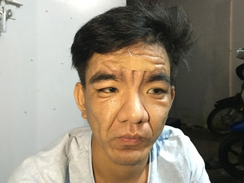 Anh Nghĩa với khuôn mặt "ông lão" hiện nay. Ảnh: thanh niên. Anh Nghĩa với khuôn mặt "ông lão" hiện nay. Ảnh: thanh niên.
