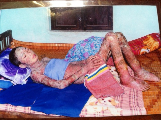 Hồ Thị Linh chống chọi với những cơn đau hàng ngày Hồ Thị Linh chống chọi với những cơn đau hàng ngày