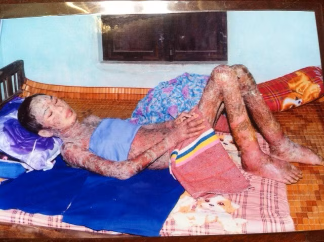 Hồ Thị Linh chống chọi với những cơn đau hàng ngày