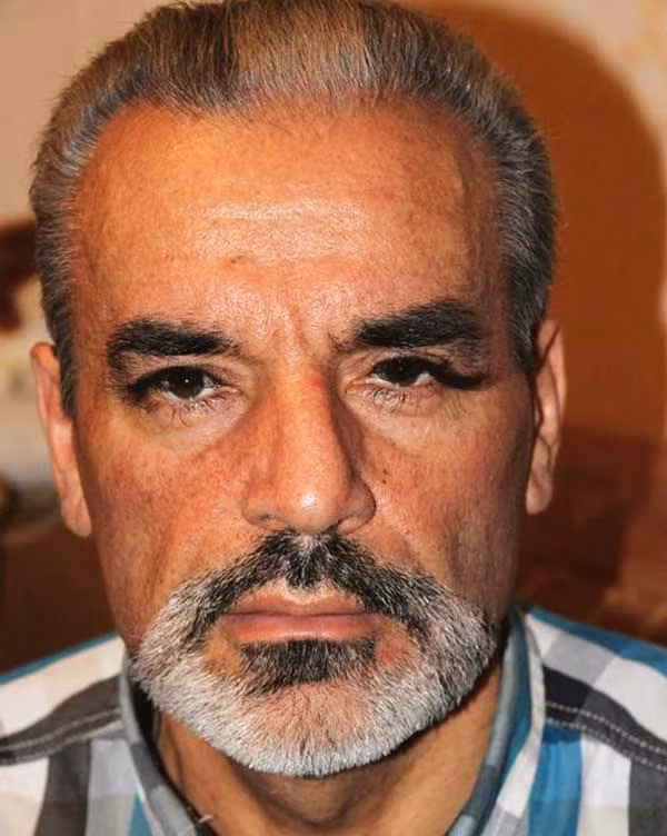 Kỳ lạ người đàn ông có lông mi ngày càng dài ảnh 1