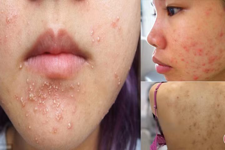 Làn da bị phá hủy vì thói quen dùng dầu dừa sai cách của hàng nghìn chị em