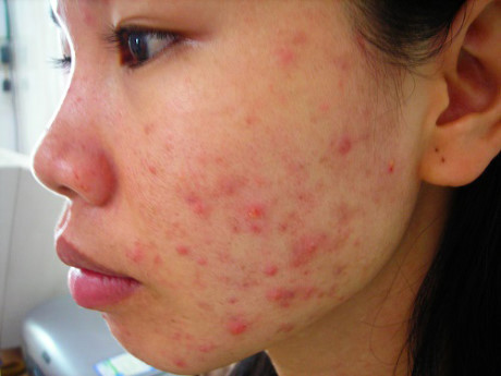 Làn da bị phá hủy vì thói quen dùng dầu dừa sai cách của hàng nghìn chị em - Ảnh 4 Lan da bi pha huy vi thoi quen dung dau dua sai cach cua hang nghin chi em - Anh 4