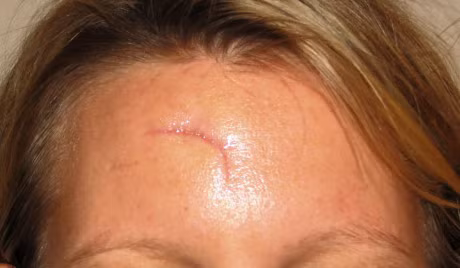 Tranh dung tay boc vay vet thuong sau phau thuat qua som - Anh 1