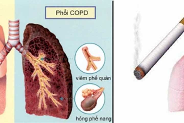 Làm sạch phổi khỏi tác hại của thuốc lá nhờ uống loại nước "thần" trong 2 tuần