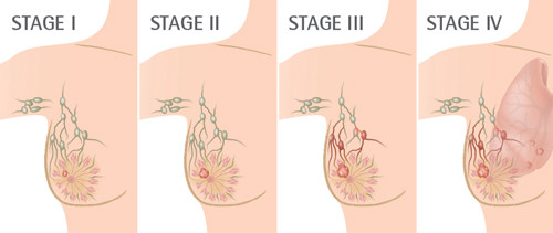 phòng ngừa ung thư