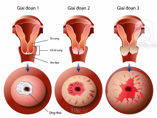 phòng ngừa ung thư