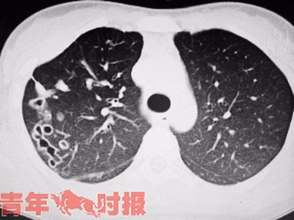 Ăn quá nhiều gỏi hải sản, cô gái 23 tuổi bị sán lá phổi