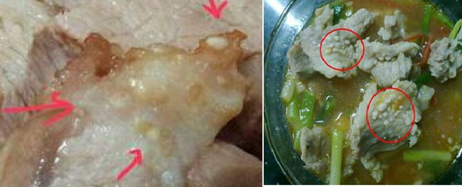 Hình ảnh ấu trùng sán gạo heo trong thực phẩm - Ảnh: Bác sĩ cung cấp. Động kinh, mù mắt vì sán gạo heo làm tổ trên da