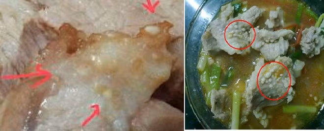 Hình ảnh ấu trùng sán gạo heo trong thực phẩm - Ảnh: Bác sĩ cung cấp. Động kinh, mù mắt vì sán gạo heo làm tổ trên da