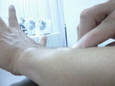 Sán gạo heo làm tổ trên da - Ảnh: Bác sĩ cung cấp. Sán gạo heo làm tổ trên da - Ảnh: Bác sĩ cung cấp.