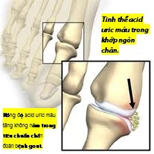 Tăng acid uric máu, có phải bị gút?