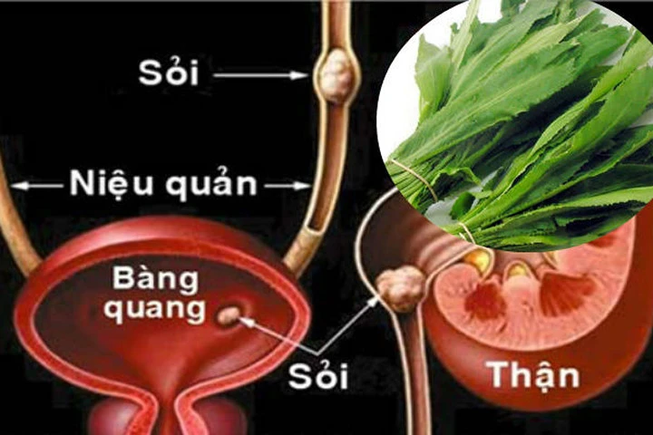 Dùng mùi tàu theo cách này, sỏi trong thận có thể sẽ đào thải hết ra ngoài sau 7 ngày