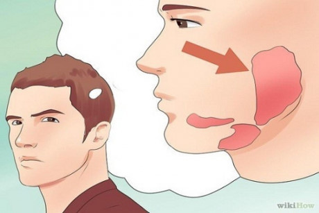 Khi chữa trị bệnh quai bị không đúng cách có thể dẫn đến nhiều biến chứng - Ảnh 2 Khi chua tri benh quai bi khong dung cach co the dan den nhieu bien chung - Anh 2