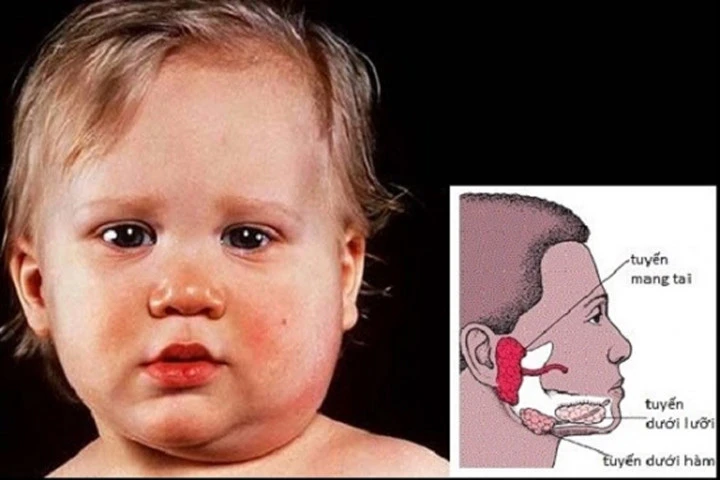 Khi chữa trị bệnh quai bị không đúng cách có thể dẫn đến nhiều biến chứng
