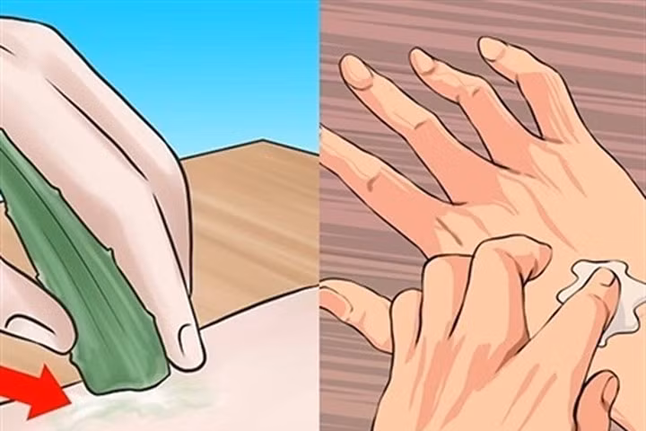 Áp dụng biện pháp này, chốc lở nặng đến mấy cũng khỏi hẳn sau 3 ngày