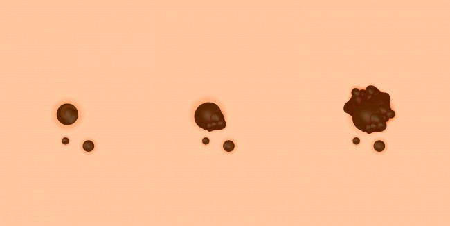 Nốt ruồi lạ. Nếu bé có một nốt ruồi không đối xứng, màu sắc bất thường và lớn (hơn 6mm) xuất hiện trên cơ thể hoặc nốt ruồi có sẵn bắt đầu lớn lên, bố mẹ cần đưa bé đi gặp bác sĩ. Nốt ruồi lạ. Nếu bé có một nốt ruồi không đối xứng, màu sắc bất thường và lớn (hơn 6mm) xuất hiện trên cơ thể hoặc nốt ruồi có sẵn bắt đầu lớn lên, bố mẹ cần đưa bé đi gặp bác sĩ.