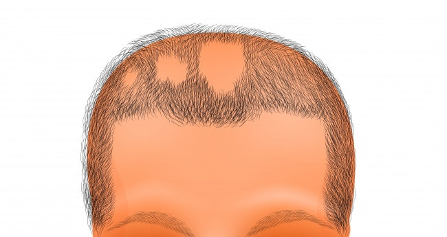 Rụng tóc. Nguồn gốc của vấn đề này có thể từ bên trong cơ thể. Nguyên nhân có thể do thiếu vitamin. Bác sĩ sẽ nói cho bạn biết nguyên nhân thực sự. Rụng tóc. Nguồn gốc của vấn đề này có thể từ bên trong cơ thể. Nguyên nhân có thể do thiếu vitamin. Bác sĩ sẽ nói cho bạn biết nguyên nhân thực sự.