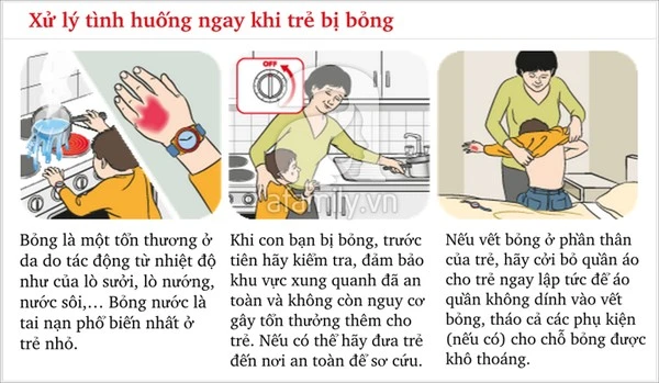 Cách xử trí khi trẻ bị bỏng bố mẹ cần phải biết