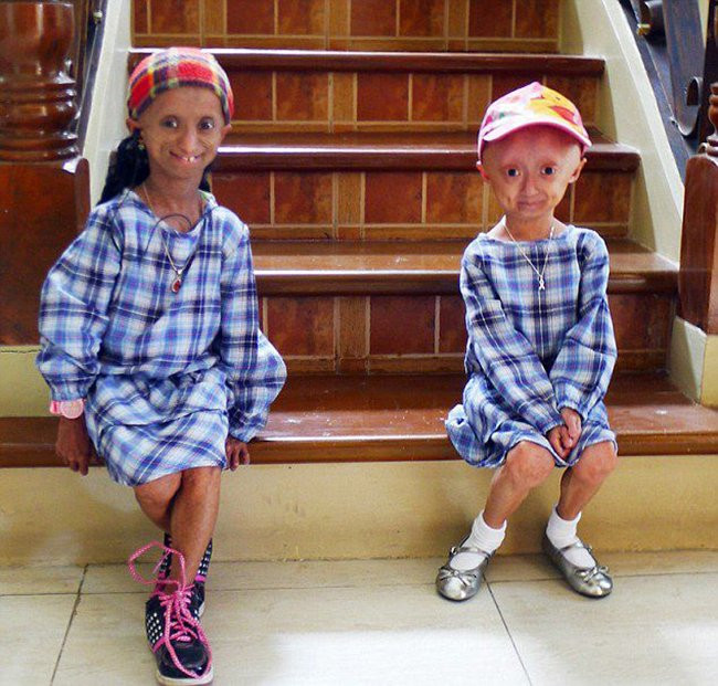 Những chứng bệnh hiếm gặp nhất trên thế giới ảnh 3