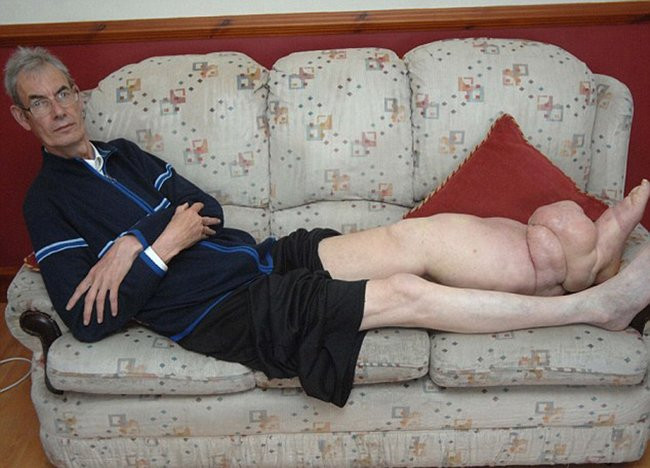 Những chứng bệnh hiếm gặp nhất trên thế giới ảnh 5