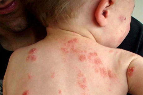 Vì sao mùa đông trẻ nhỏ, người lớn bị ngứa- gãi đến chảy máu? - Ảnh 2 Vi sao mua dong tre nho, nguoi lon bi ngua- gai den chay mau? - Anh 2