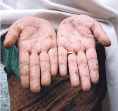 Bieu hien cua nhiem doc asen - Anh 1