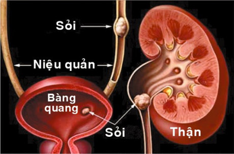 Tự ý dùng thuốc nam chữa sỏi thận: Coi chừng tử vong - Ảnh 2 Tu y dung thuoc nam chua soi than: Coi chung tu vong - Anh 2