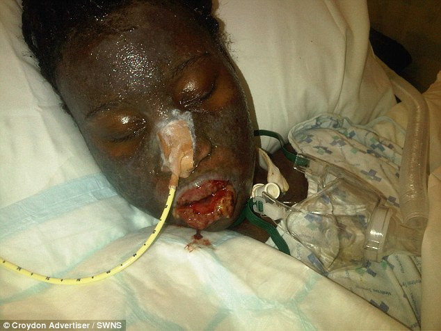 Cô gái suýt chết vì dị ứng thuốc nhỏ mắt - Ảnh 2