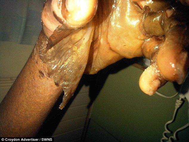 Cô gái suýt chết vì dị ứng thuốc nhỏ mắt - Ảnh 3