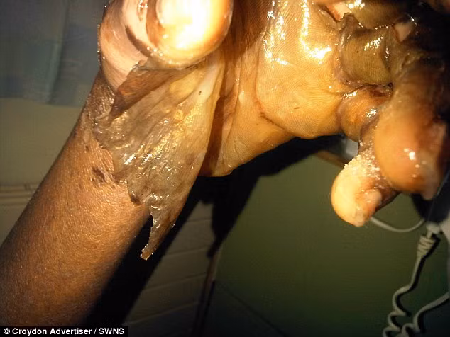 Cô gái suýt chết vì dị ứng thuốc nhỏ mắt - Ảnh 3