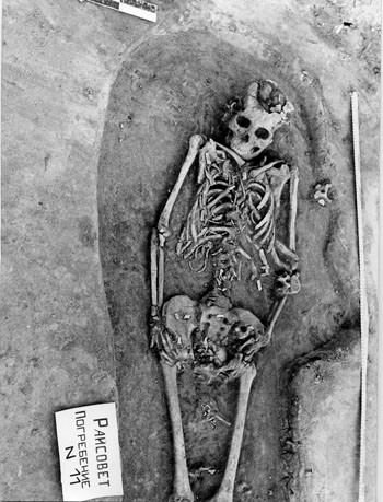 Xương của thai nhi có thể nhìn thấy rõ ở vùng xương chậu, quanh vùng bụng và đùi của người mẹ. Ảnh: Vladimir Bazaliiskii