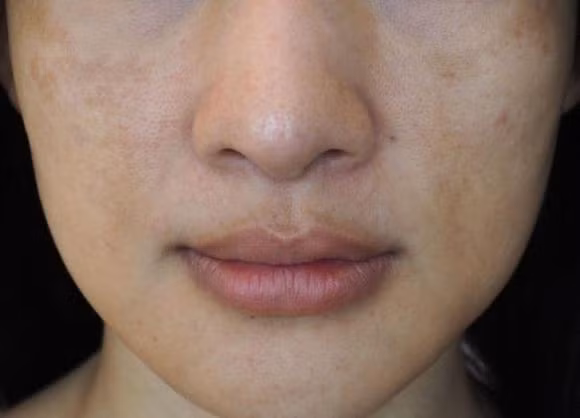 8 sai lầm khi chăm sóc da khiến lỗ chân lông ngày càng to ảnh 4