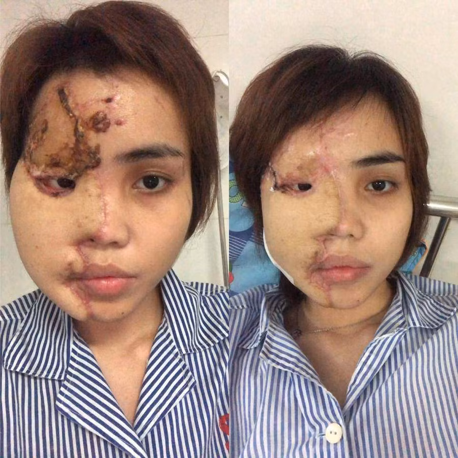 Sau hơn 1 năm, cô gái bị chồng sắp cưới là thiếu úy công an tạt axit giờ ra sao? ảnh 2