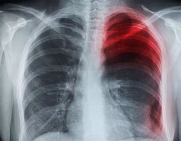 Hình ảnh chụp CT cho thấy Tiểu Lý bị tràn khí màng phổi, chảy máu.