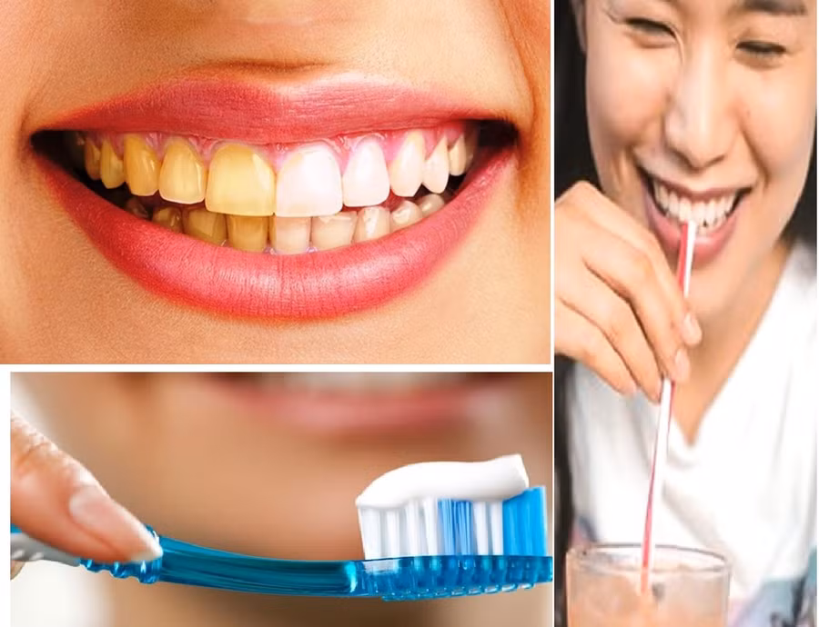 Thói quen hàng ngày bạn không ngờ tới dẫn đến ố răng. Đồ họa: NC.
