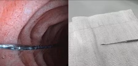 Hình ảnh dị vật trước và sau khi được các bác sĩ lấy ra. 