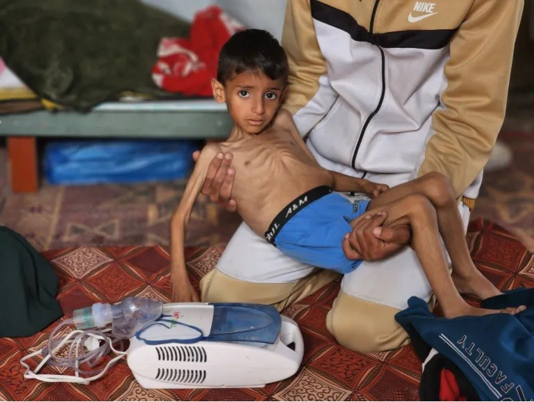 Bé Osama Kamal al-Raqab đang được điều trị suy dinh dưỡng tại Khan Younis, phía nam Gaza, ngày 14/4. Ảnh: Hani Alshaer/Anadolu.