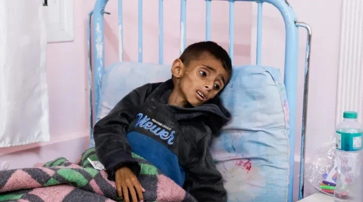 Nhiều trẻ em ở Gaza bị suy dinh dưỡng nghiêm trọng.