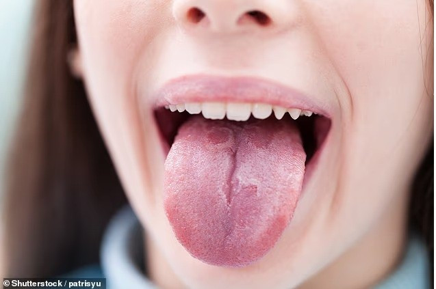 Hiện tượng bề mặt lưỡi xuất hiện các vệt loang lổ giống bản đồ xảy ra khi lớp bề mặt "cũ" của lưỡi tái tạo nhưng lớp trên cùng không bong ra đúng cách. luoi-ban-tiet-lo-dieu-gi-ve-suc-khoe-3.jpg
