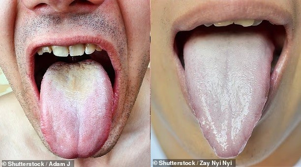 Lớp phủ màu vàng (hình trái) có thể cho thấy cơ thể đang bị nhiễm trùng. Trong khi đó, lưỡi có màu hồng nhạt (hình phải) có thể gợi ý tình trạng thiếu vitamin hoặc hệ miễn dịch yếu. luoi-ban-tiet-lo-dieu-gi-ve-suc-khoe-5.jpg