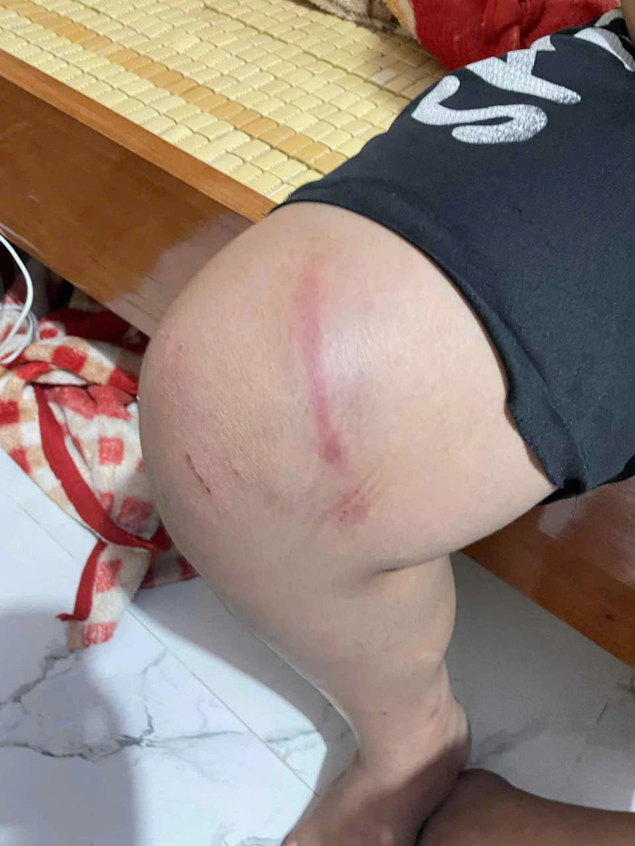 Đầu gối bị thương. z6804710402349-ed58b1f1d38b9b2aeb524df9b2b21270.jpg