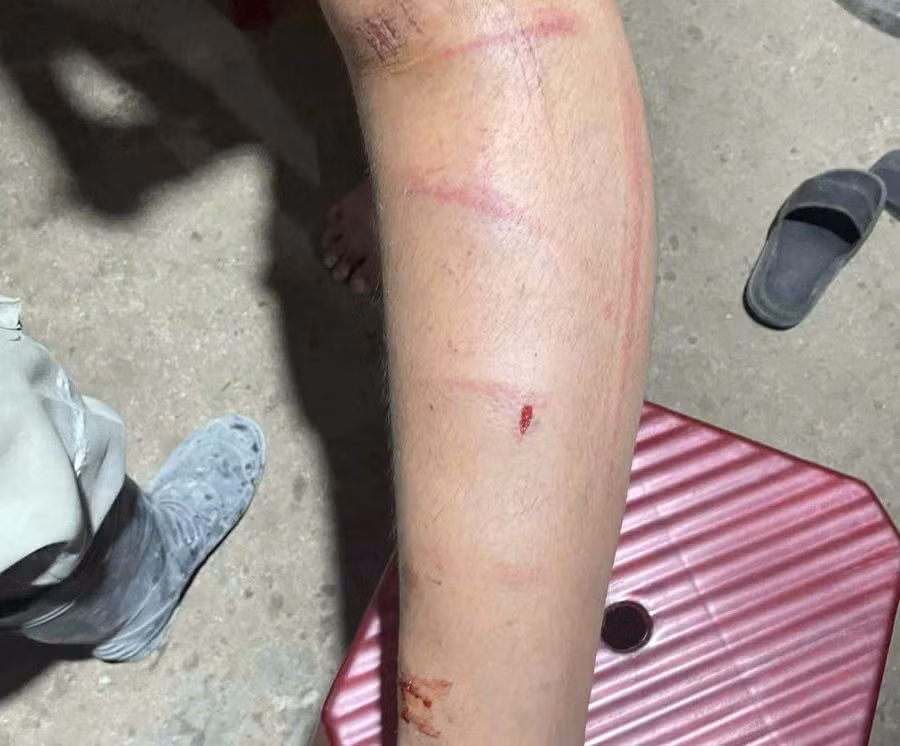 Nam sinh lớp 8 tại TP Huế bị xích chân và đánh đập, trên người có nhiều vết thương.