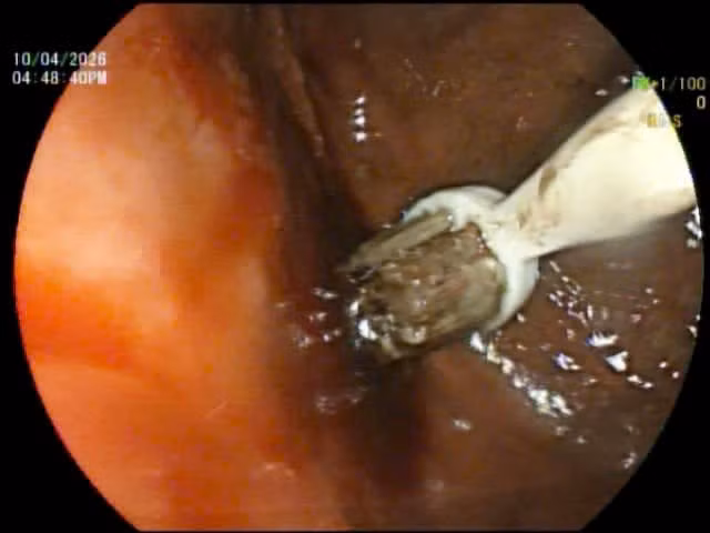 1 trong 3 bàn chải được nội soi và gắp ra trong đường tiêu hóa bệnh nhân điều trị tại Bệnh viện Trung ương Huế.