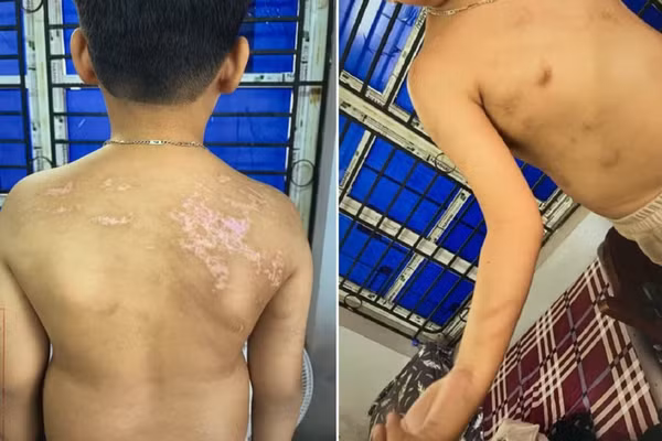 Cháu N.Đ.B.K có 21 vết sẹo và 20 vết rối loạn sắc tố da màu nâu.