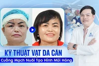 Sửa mũi hỏng tạo hình cánh mũi bằng kỹ thuật vạt da cân có cuống mạch nuôi