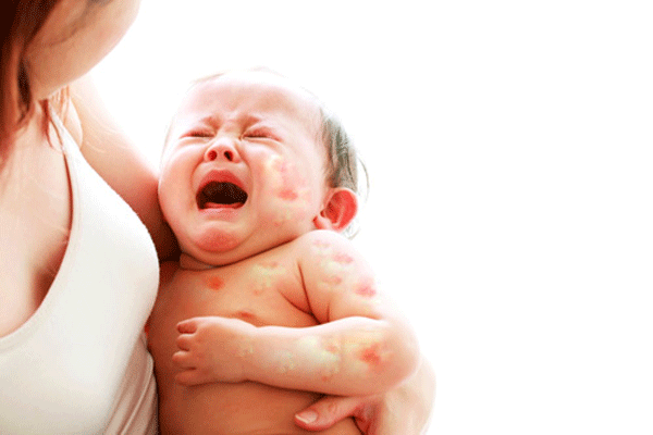 Phát ban, khó thở, nôn trớ... là những biểu hiện thường gặp ở trẻ bị dị ứng đạm bò.